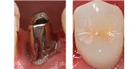 implant supported crown fixed with dental cement