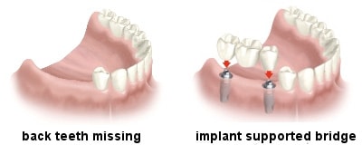 dental implants indication: posterior teeth missing