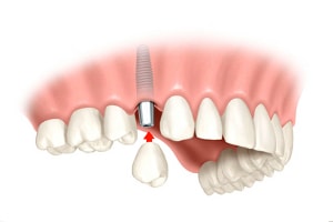 dental implant-supported crown