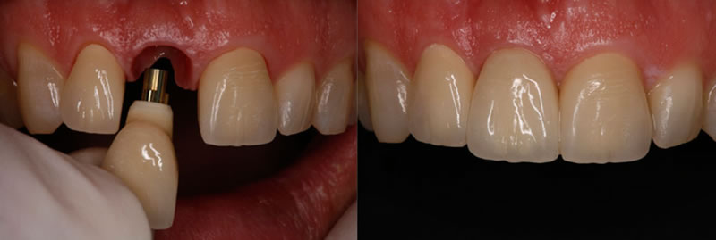 implant supported crown before and after