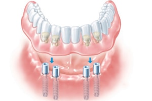 overdenture supported by dental implants