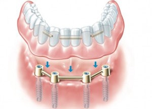 dental implant-supported denture