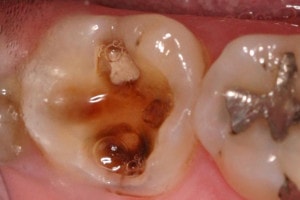 large cavity with advance tooth destructions