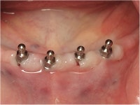 special retainer abutments : male-adapters attached to the implants