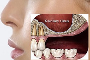 dental implants temporary contraindication: maxillary sinus lowering
