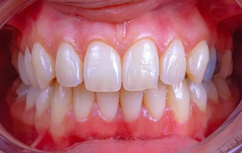 Minimally Invasive Veneers