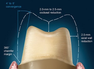dental crown procedure : molar preparation