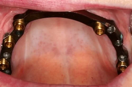 overdenture supported by dental implants
