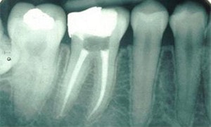 dental radiography periapical view