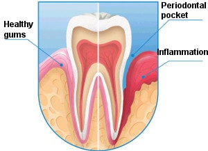 periodontal pocket