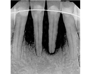 periodontitis with advanced bone loss