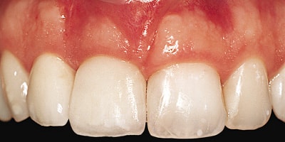 porcelain crowns on the 2 central incisors