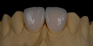porcelain veneers on a dental mould