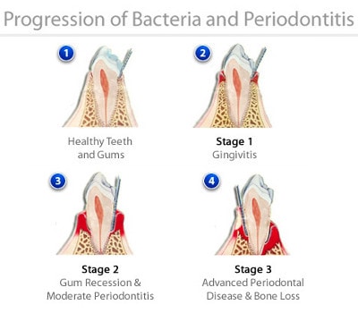 progression of periodontal disease