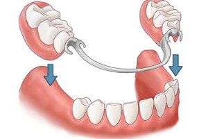 removable denture chewing forces