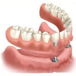removable denture supported by implants
