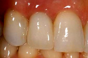 same day dental implant
