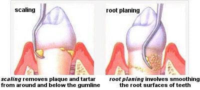 scaling and root planing