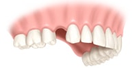 dental implant indication: single unit toothless gap