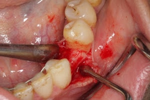 dental implant procedure : soft tissue reflection