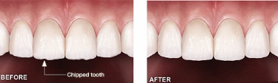 teeth reshaping