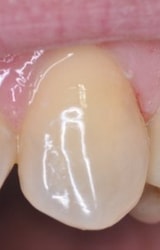 natural tooth before preparation