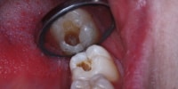 physical examination : tooth cavity
