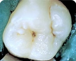 tooth decay enamel