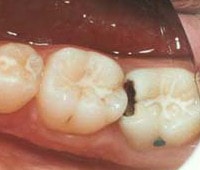 teeth decays in the interproximal sites between two teeth