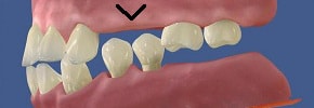 toothless gap vertical shrinkage