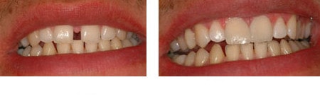 veneers indications: closing gaps between teeth