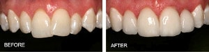 veneers indications: make crooked teeth appear straight