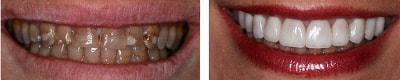 veneers indications: whitening teeth