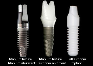 zirconia implants and titanium implants