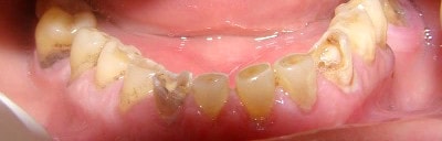 abrazia dentara este una din indicatiile restaurarilor prin punti dentare