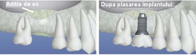 aditie de os pentru un implant dentar