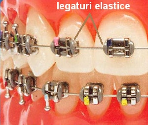 aparat dentar clasic