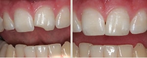 bonding dentar : imbunatatirea aspectului unui dinte ciobit