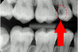 carii dentare pe radiografie