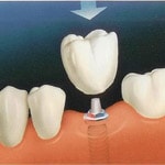 coroana dentara pe implant