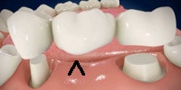 corpul unei punti dentare cu 1 element