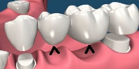 corpul unei punti dentare cu 2 elemente
