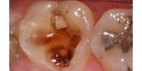 lucrari dentare : dinte cariat cu pereti putin rezistenti