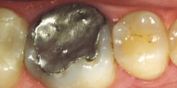 lucrari dentare : dinte cu obturatie metalica mare