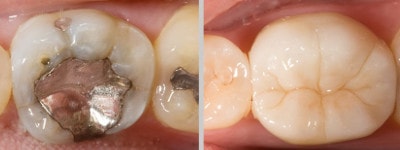 coroane dentare, indicatii: dinte cu obturatie mare ce trebuie inlocuita