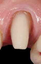coroane dentare : dinte dupa slefuire