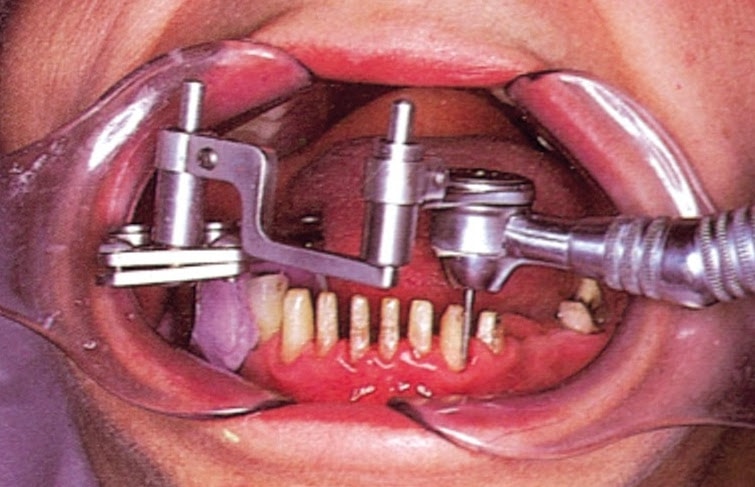 lucrari dentare: dizpozitiv ajutator folosit pentru paralelismul dintilor slefuiti