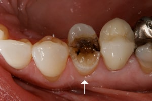 pivot dentar, indicatii : distructia avansata a coroanei unui dinte