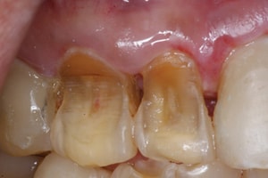 eroziunea dentara