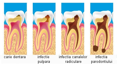 carii dentare : evolutie